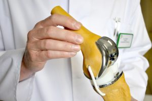 So sieht eine moderne Knieprothese aus. Foto: Jennifer Grundtner/Kreiskrankenhaus Mechernich GmbH